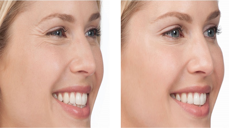 پزشک زیبایی اصفهان بوتاکس صورت