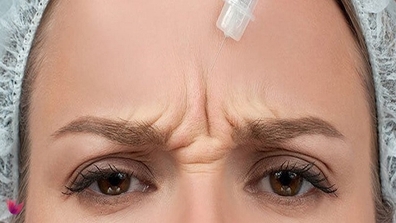 فیلر خط اخم