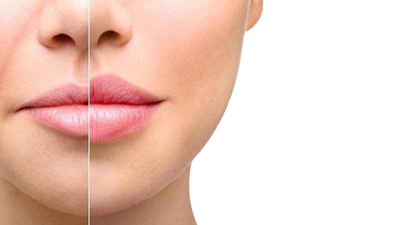 فیلر لب