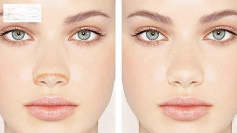 پلاسما بینی