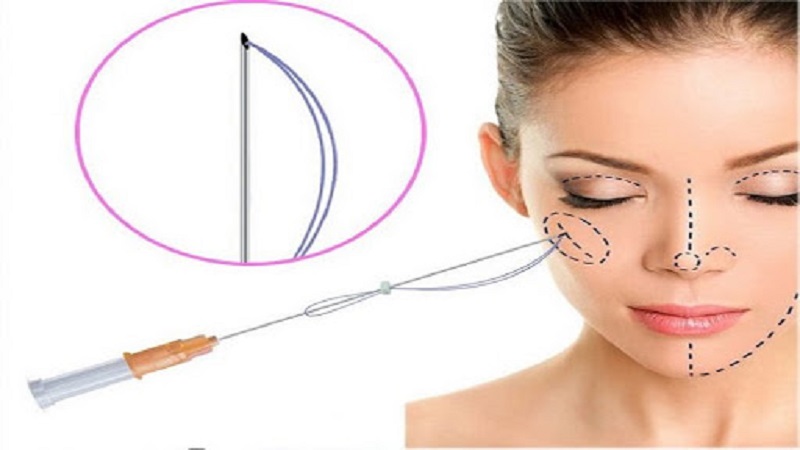 سن مناسب جهت لیفت با نخ کلاژنساز