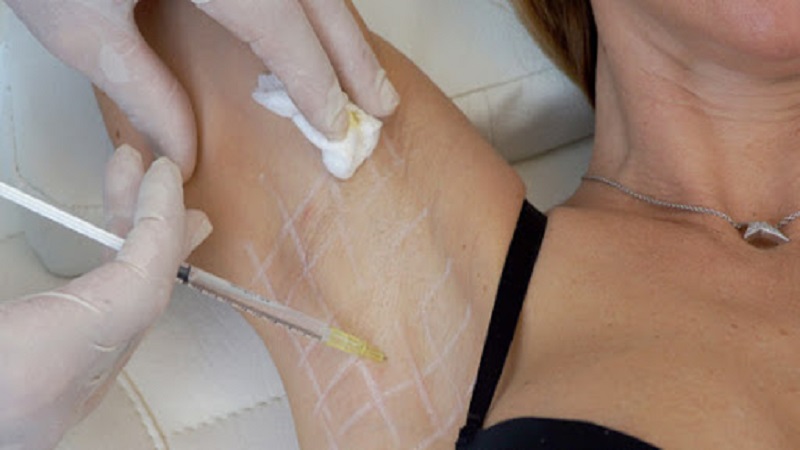 پزشک زیبایی اصفهان عوارض بوتاکس زیر بغل