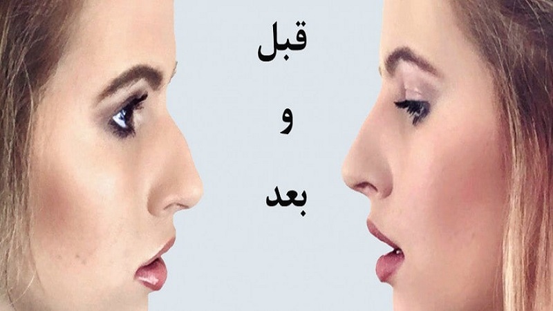 زیبایی بینی بدون جراحی با تزریق ژل