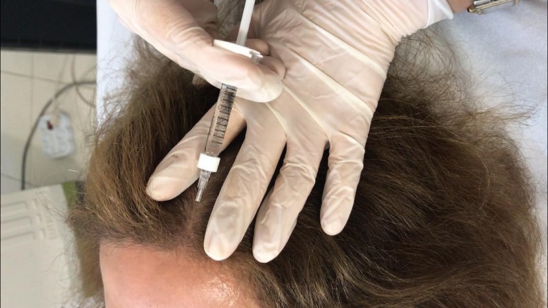 پزشک زیبایی اصفهان فیلر مو