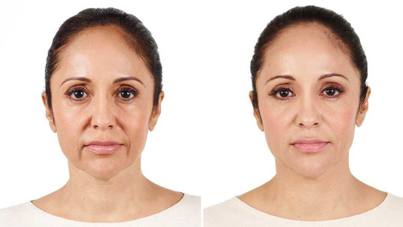 پزشک زیبایی اصفهان |تزریق فیلر برای خط خنده