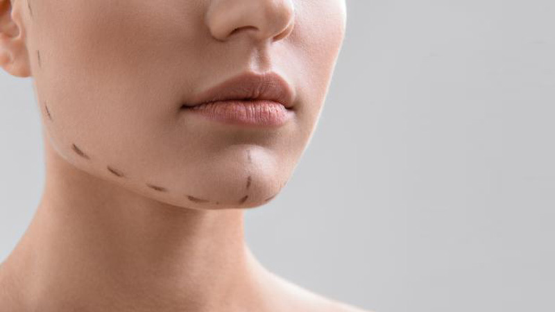 تزریق فیلر در چانه