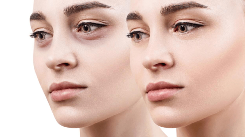 پزشک زیبایی اصفهان | مدت زمان بهبودی تزریق فیلر