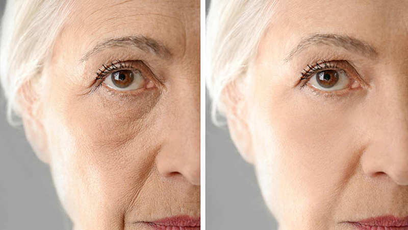 بهترین پزشک زیبایی اصفهان | ژل رووفیل چیست؟