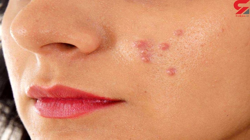 انواع آکنه در نوجوانان