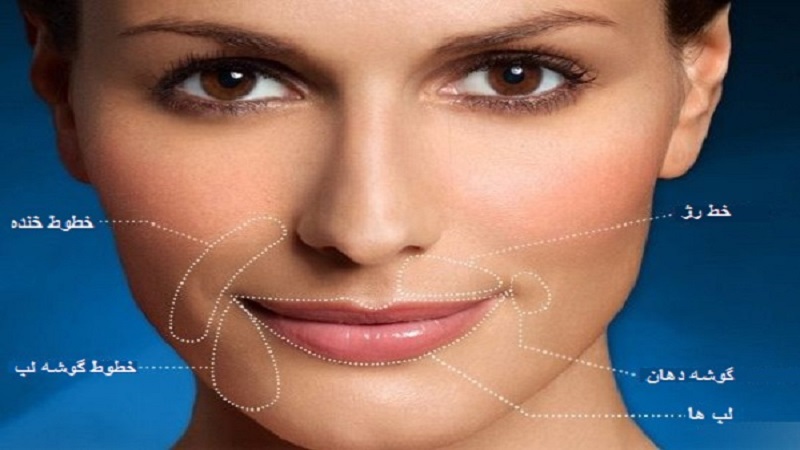 از بین بردن خط خنده