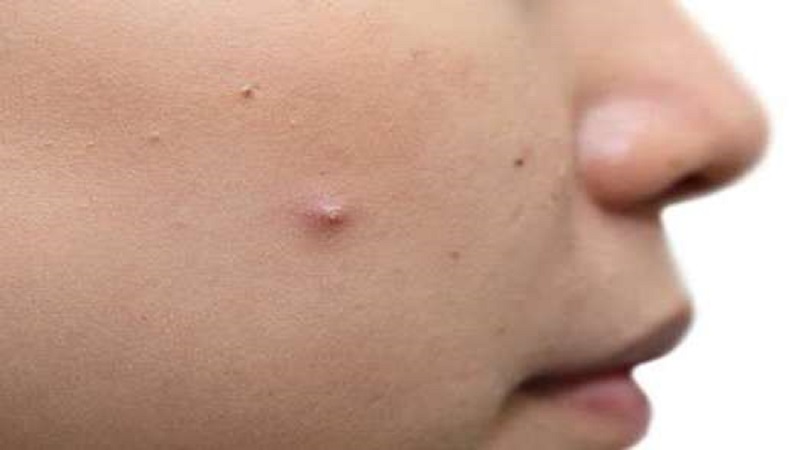 بهترین پزک زیبایی اصفهان | درمان جوش سر سفید