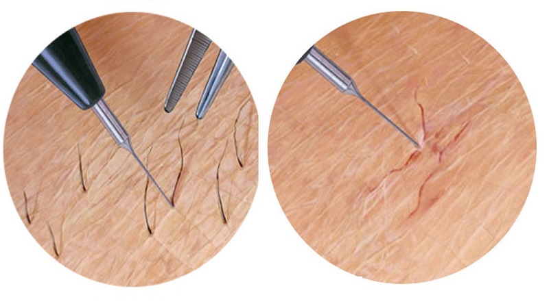 عوارض جانبی الکترولیز