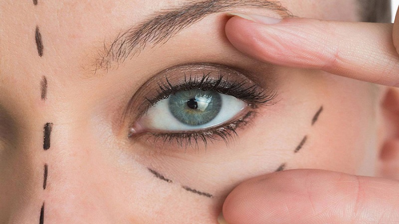 بلفاروپلاستی با پلاسما جت | پزشک زیبایی اصفهان