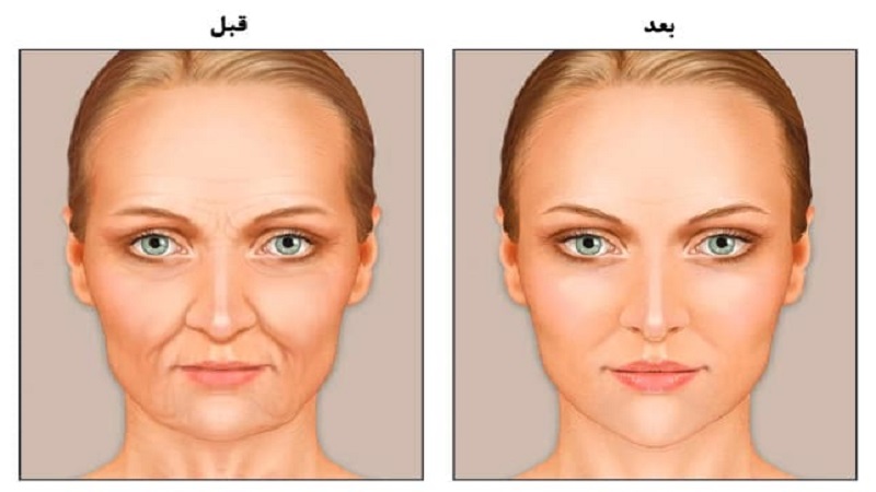 تزریق چربی برای افراد لاغر