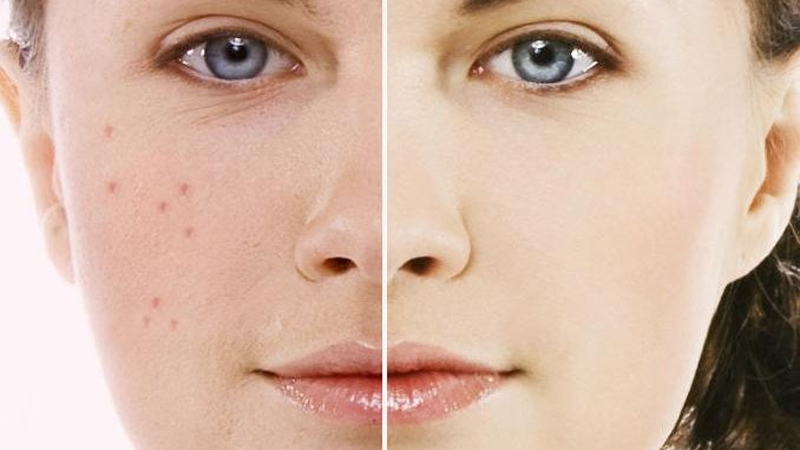 نحوه درمان آکنه با زینک-PCA | پزشک زیبایی اصفهان