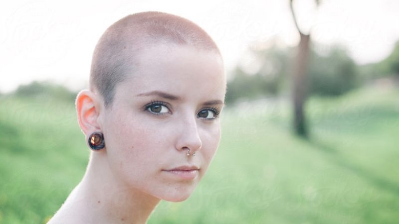 آشنایی با بیماری طاسی با الگوی زنانه | پزشک زیبایی اصفهان