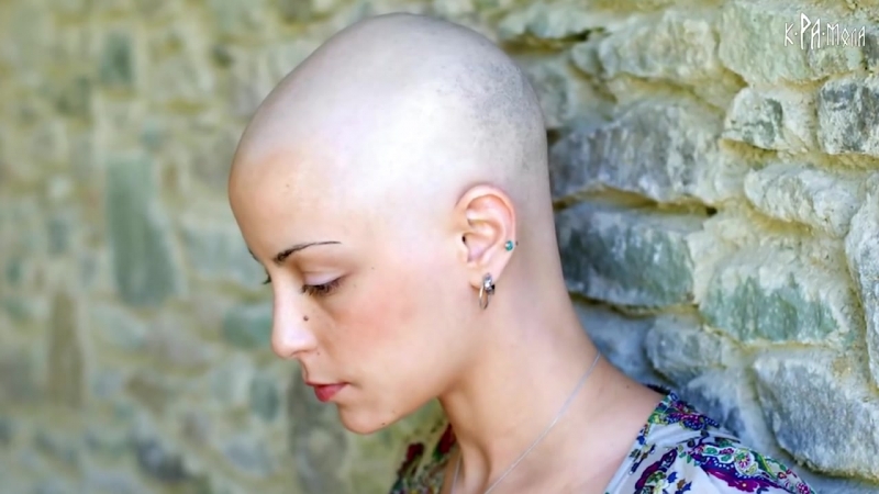 آشنایی با بیماری طاسی با الگوی زنانه