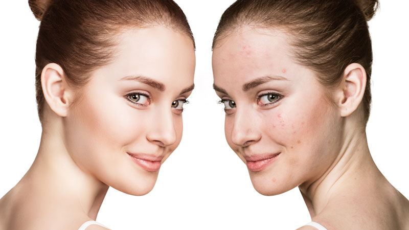 درمان آکنه با استفاده از نیاسینامید