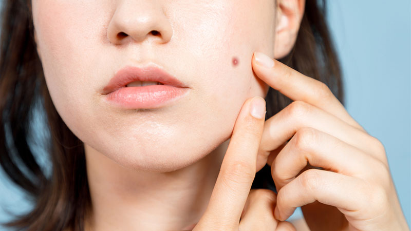 علل و درمان منگوله‌ی پوستی | پزشک زیبایی اصفهان