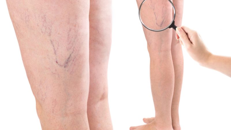 پیشگیری از رگ‌های واریسی و عنکبوتی در بارداری