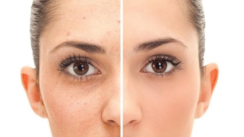 درمان جوش و آکنه در بارداری | پزشک زیبایی اصفهان