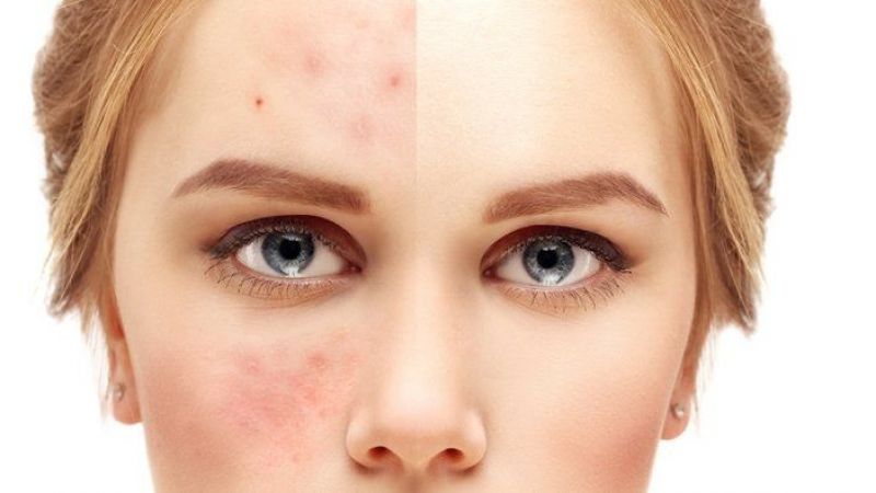 درمان جوش و آکنه در بارداری