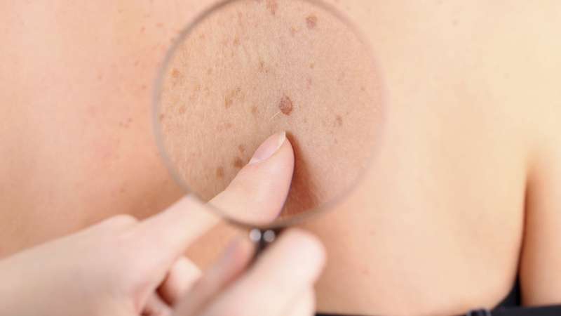 بررسی علائم و عوارض بیماری زونا | پزشک زیبایی اصفهان