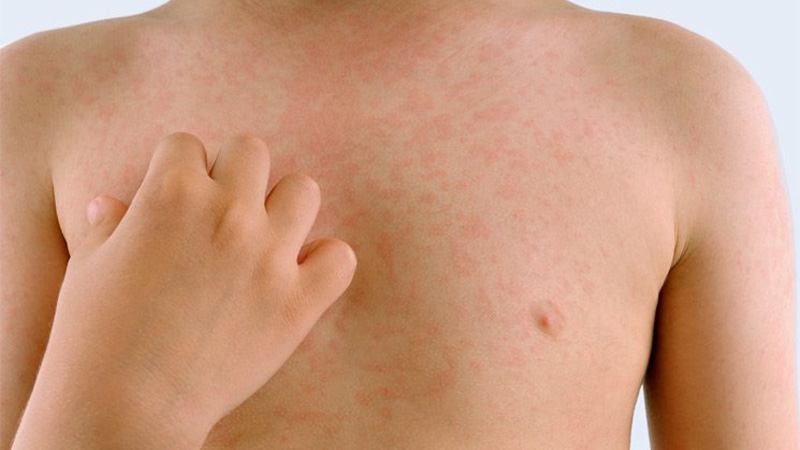 راه های پیشگیری ، تشخیص و درمان بیماری زونا