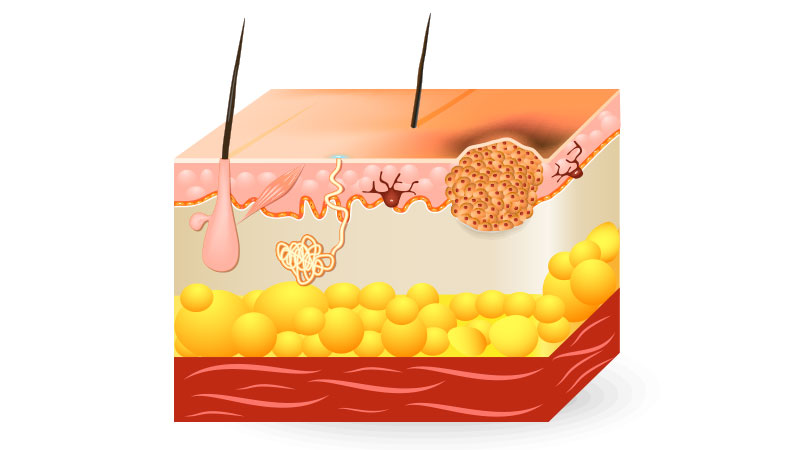 علل ، علائم و پیشگیری از سرطان سلول سنگفرشی (SCC)