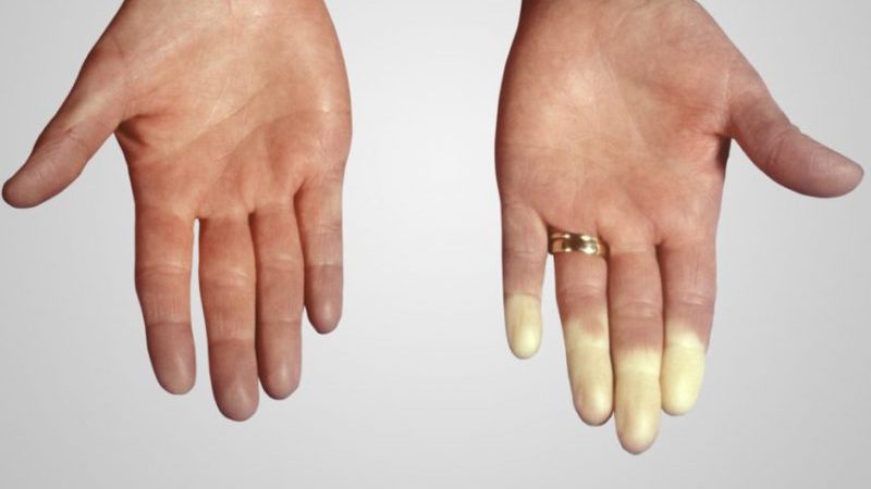 علل و علائم لوپوس و بیماری خود ایمنی | پزشک زیبایی اصفهان