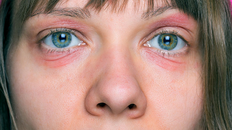 آشنایی با انواع مختلف لوپوس