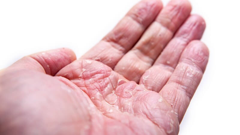 دلایل و نشانه های ایجاد اگزمای انگشتان دست | پزشک زیبایی اصفهان