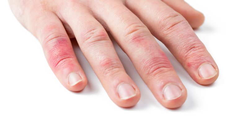 دلایل و نشانه های ایجاد اگزمای انگشتان دست