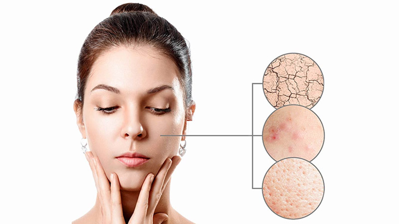 علل و علائم بروز انواع مختلف کهیر