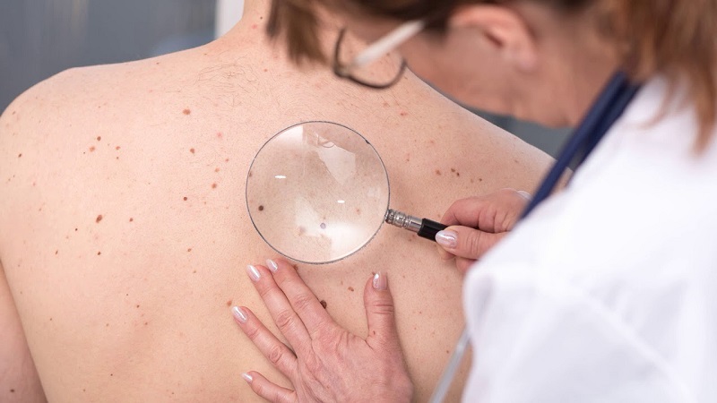 عوامل ایجاد کننده سرطان سلول‌های سنگفرشی