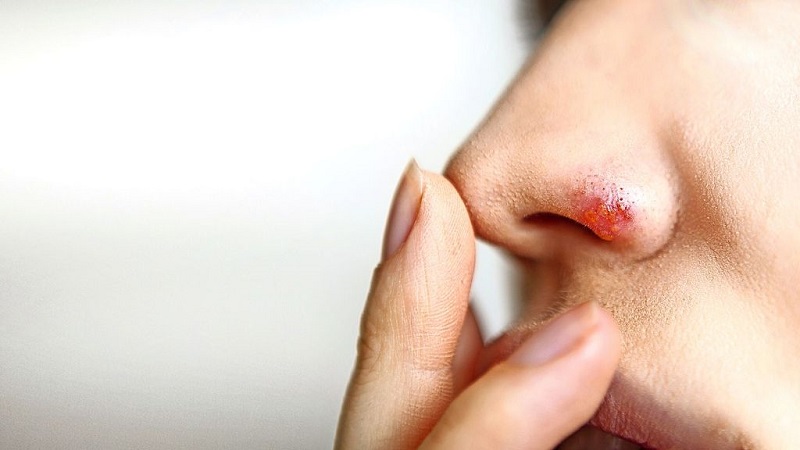 علل ، علائم و درمان تبخال چیست؟ | پزشک زیبایی اصفهان