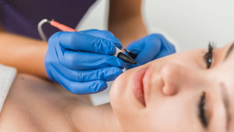 مراقبت های قبل و بعد از الکترولیز موهای زائد