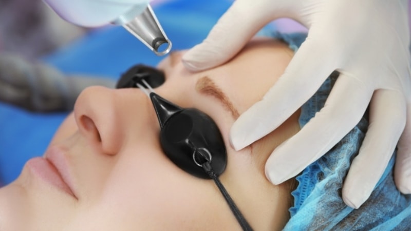 بررسی لیزر موهای زائد ابرو