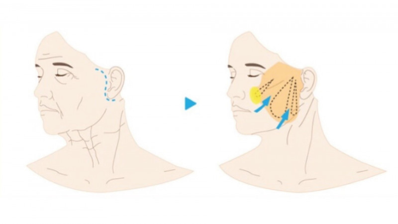 کاندید ایده آل برای لیفت صورت با نخ سیلوئت