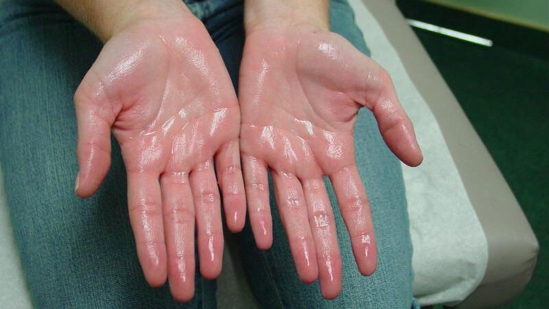 درمان هایپرهیدروزیس با تزریق بوتاکس