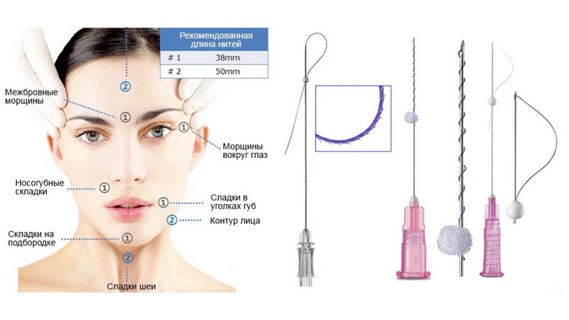 کاربرد انواع نخ لیفت