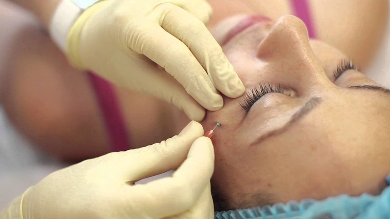 انواع گود افتادگی صورت در لیفت با نخ | پزشک زیبایی اصفهان