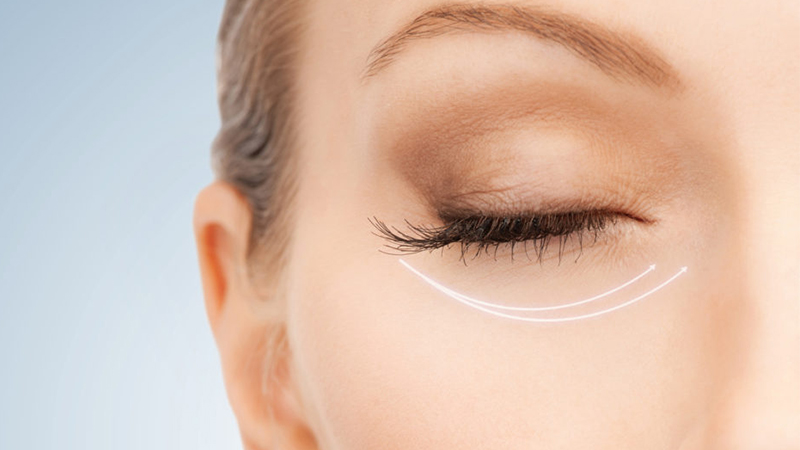 لیفت اطراف چشم