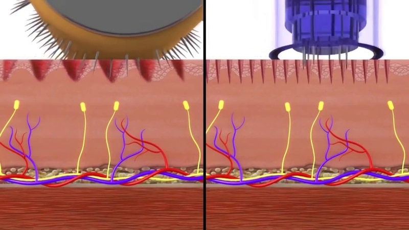 نحوه انجام میکرونیدلینگ