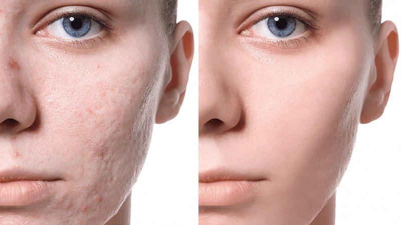 روش‌های مختلف درمان اسکار