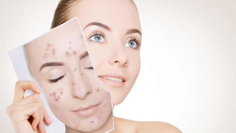 درمان جوش صورت با لیزر