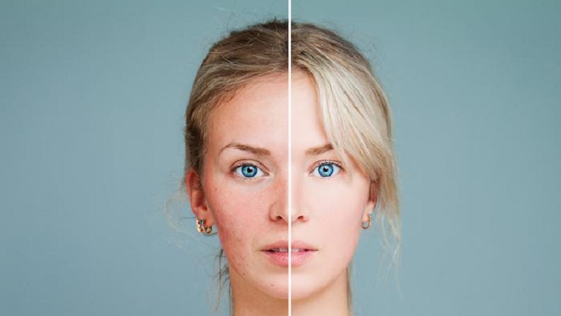 بررسی مراقبت های قبل و بعد از لیزر جوش صورت