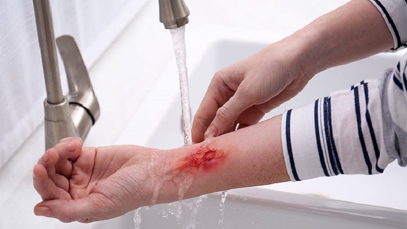 چگونگی درمان جای سوختگی