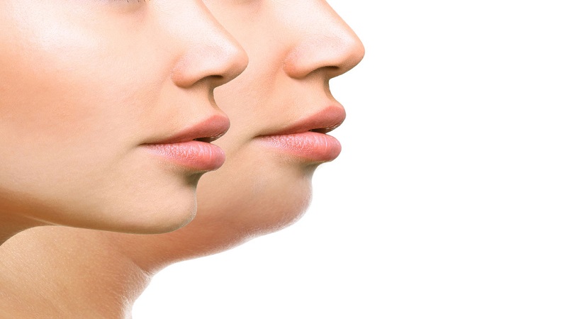 مراقبت و توصیه‌های قبل و بعد از مزوتراپی غبغب