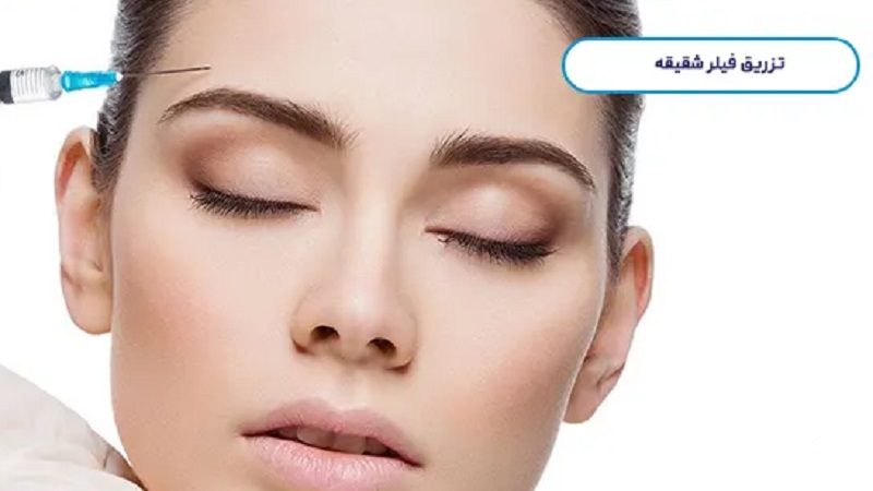 نمونه تزریق یک طرفه فیلر شقیقه